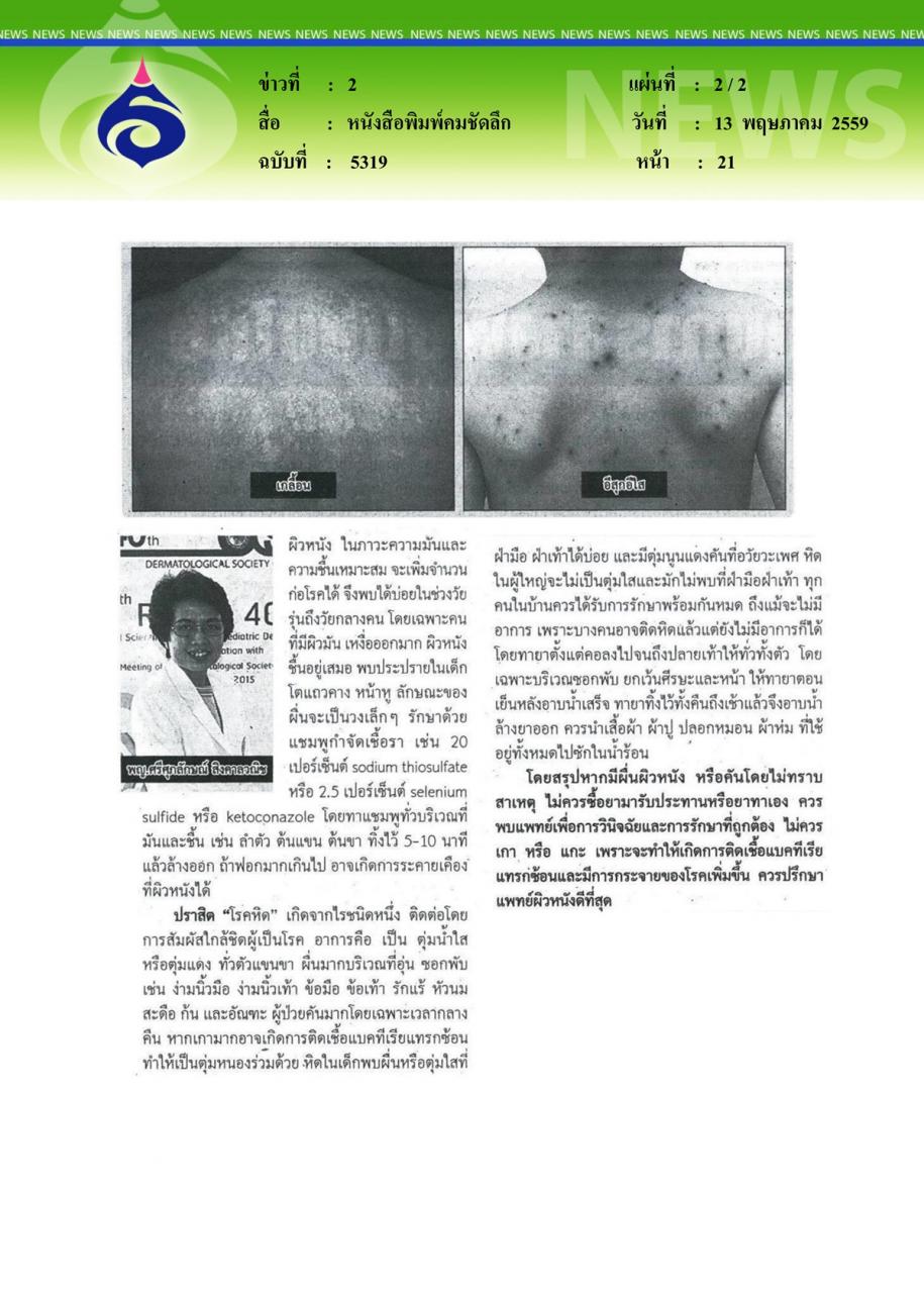หนังสือพิมพ์คมชัดลึก โรคติดเชื้อผิวหนังที่พบบ่อยในเด็ก VS ผู้ใหญ่