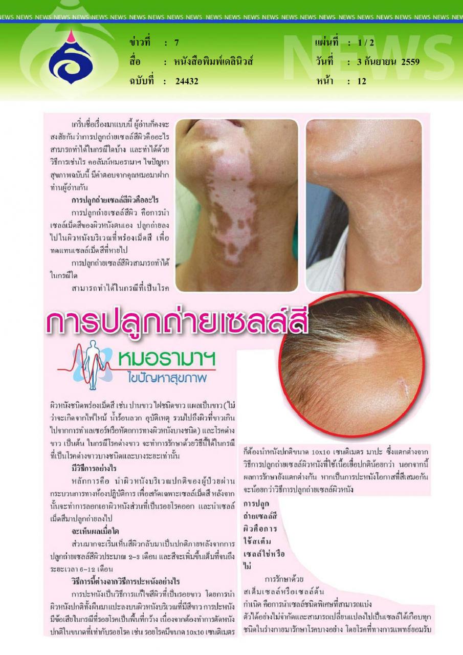 หนังสือพิมพ์เดลินิวส์ การปลูกถ่ายเซลล์สี