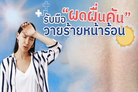 รับมือ “ผดผื่นคุ้น” วายร้ายหน้าร้อน