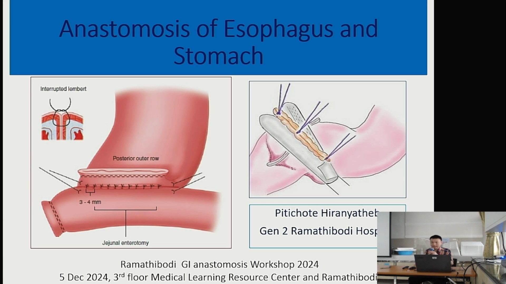 Upper GI anastomosis: Pitichote Hiranyatheb.MD. (05/12/24)