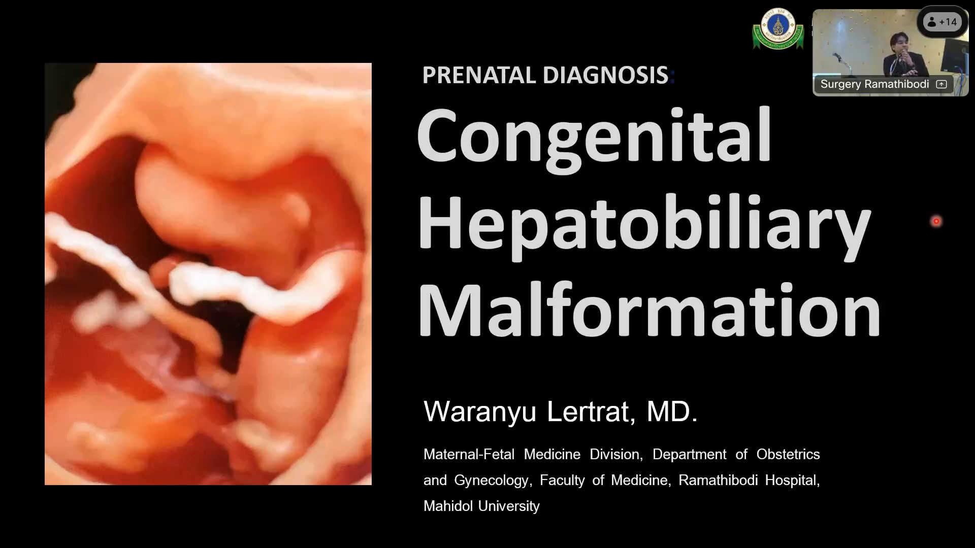 9.PRENATAL DIAGNOSIS OF CONGENITAL HEPATOBILIARY MALFORMATION: WARANYOO LERTRAT