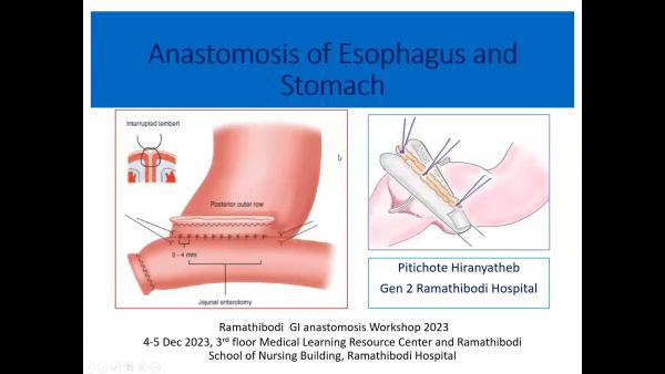 Anastomosis of Esophagus and Stomach