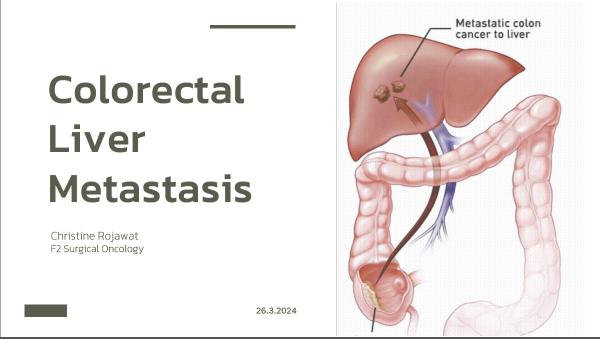 Colorectal Liver Metastasis