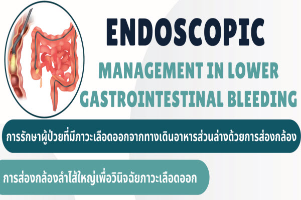 Endoscopic Lower GI bleeding