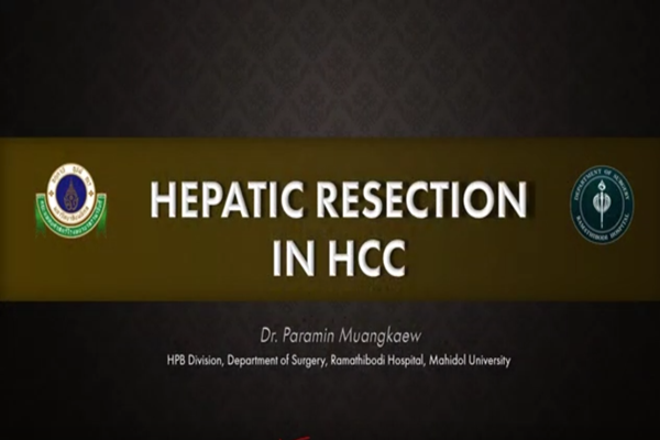 Hepatic resection in HCC for resident (Thai)