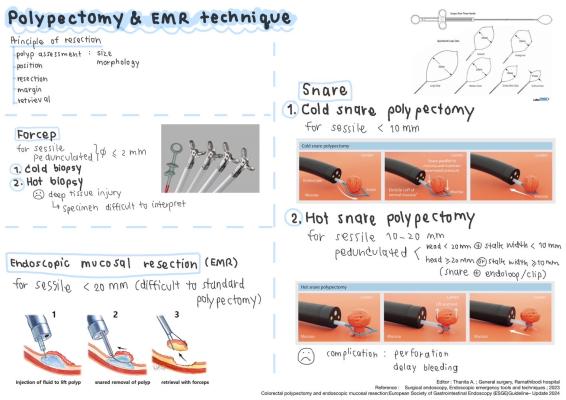 Polypectomy