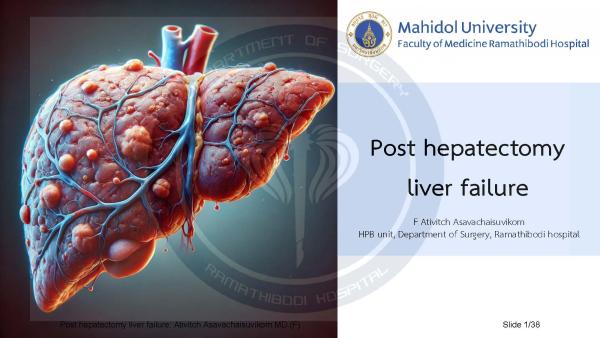 Post hepatectomy liver failure