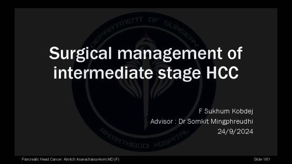 Surgical management of intermediate stage HCC
