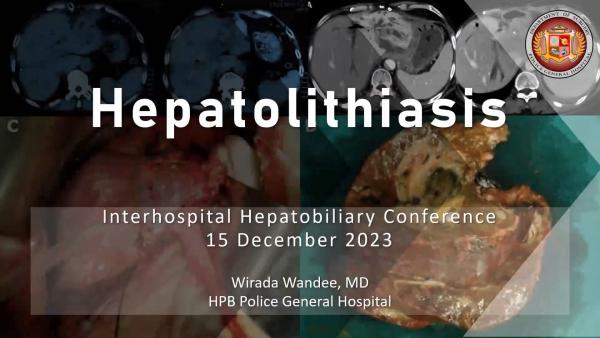 Hepatolithiasis