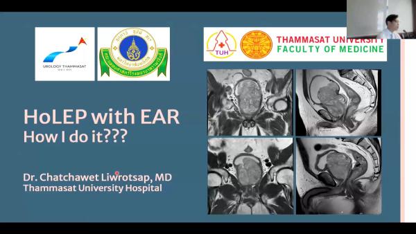 HoLEP with EAR