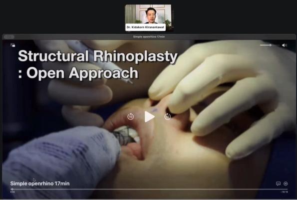 Structural rhinoplasty