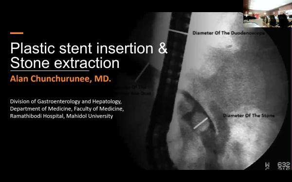 Stent insertion & Stone extraction